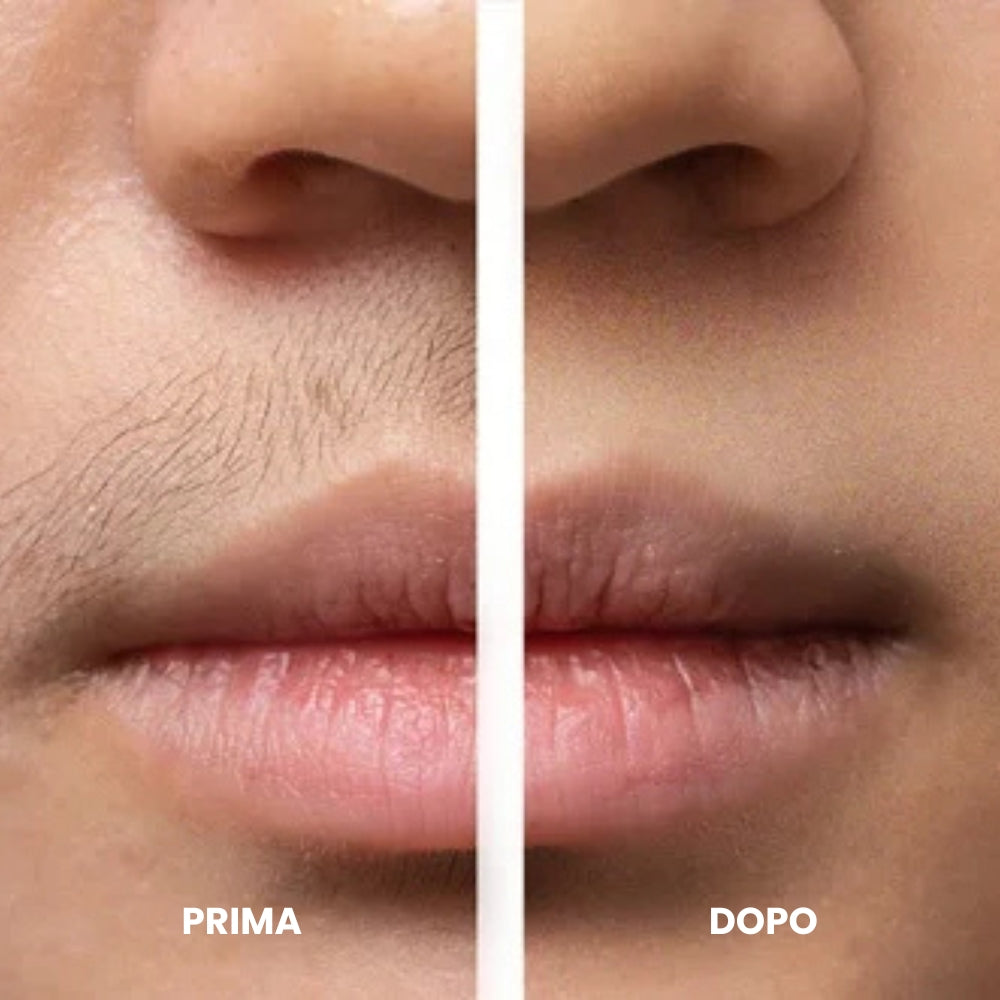 Dispositivo per la Rimozione dei Peli del Viso